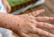 Varicela: prevenir sigue siendo fundamental Varicela: prevenir sigue siendo fundamental