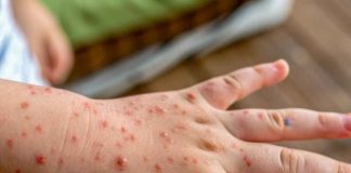 Varicela: prevenir sigue siendo fundamental