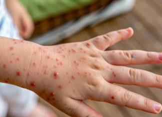 Varicela: prevenir sigue siendo fundamental