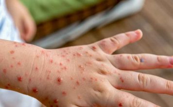Varicela: prevenir sigue siendo fundamental Varicela: prevenir sigue siendo fundamental