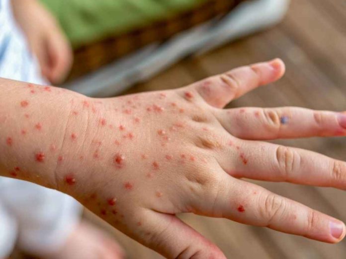 Varicela prevenir sigue siendo fundamental Varicela: prevenir sigue siendo fundamental